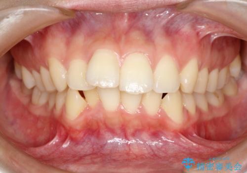 目立たない裏側装置 ハーフリンガルの抜歯矯正の症例 治療前