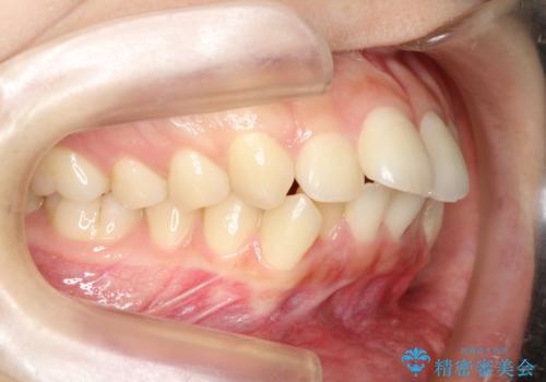 目立たない裏側装置 ハーフリンガルの抜歯矯正の治療前