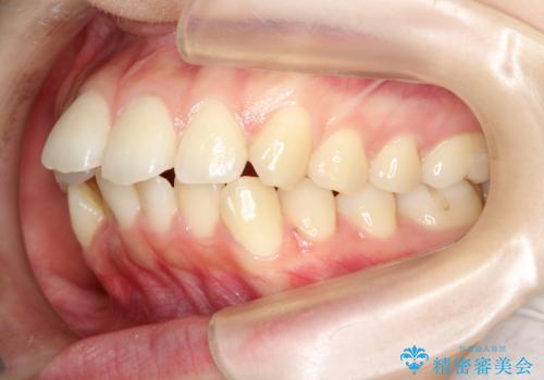 目立たない裏側装置 ハーフリンガルの抜歯矯正の治療前