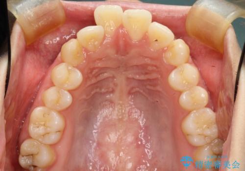 目立たない裏側装置 ハーフリンガルの抜歯矯正の治療前