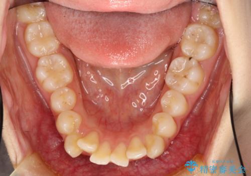 目立たない裏側装置 ハーフリンガルの抜歯矯正の治療前