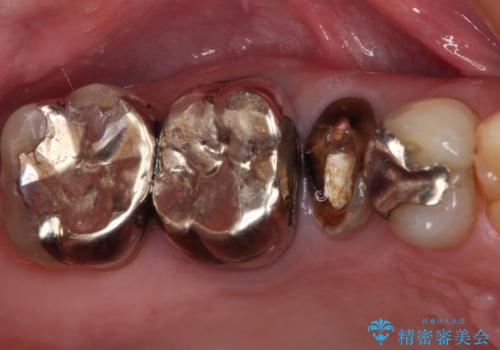 もげてしまった奥歯 オールセラミッククラウンでの補綴治療の症例 治療前