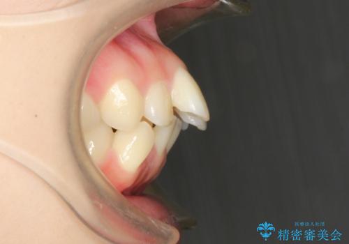 目立たない裏側装置 ハーフリンガルの抜歯矯正の治療前