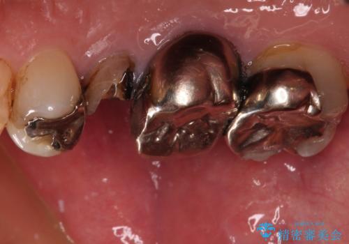 もげてしまった奥歯 オールセラミッククラウンでの補綴治療の治療前