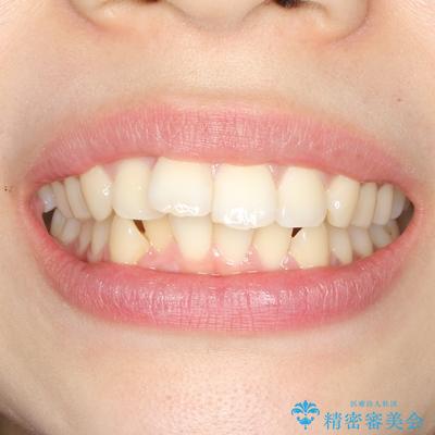 目立たない裏側装置 ハーフリンガルの抜歯矯正の治療前(顔貌)