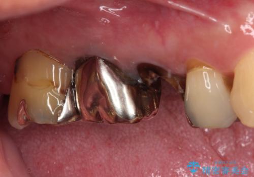 もげてしまった奥歯 オールセラミッククラウンでの補綴治療の治療前