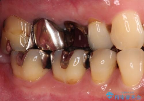 もげてしまった奥歯 オールセラミッククラウンでの補綴治療の治療前