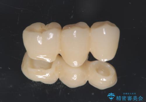 被せ物がとれた オールセラミックによるブリッジ治療の治療中