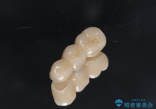 被せ物がとれた オールセラミックによるブリッジ治療の治療中