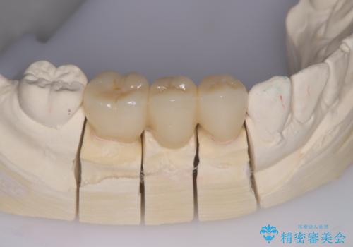 被せ物がとれた オールセラミックによるブリッジ治療の治療中