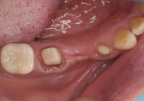 被せ物がとれた オールセラミックによるブリッジ治療の治療中