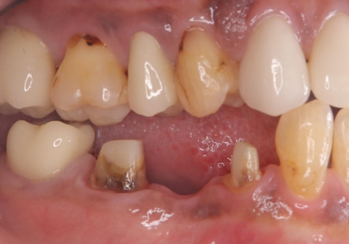 被せ物がとれた オールセラミックによるブリッジ治療の治療中