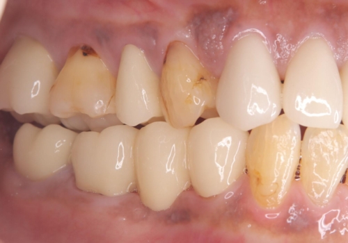 被せ物がとれた オールセラミックによるブリッジ治療の症例 治療後
