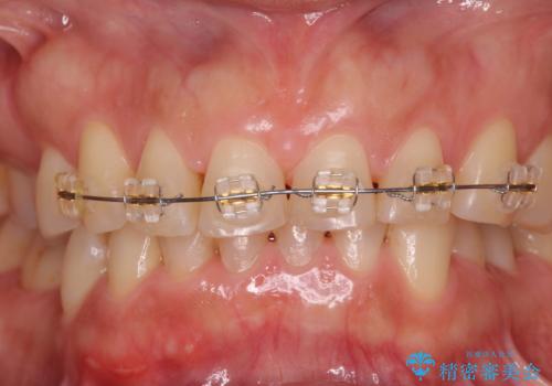 50代女性 部分矯正で 前歯の見た目改善 気になるところだけの治療中