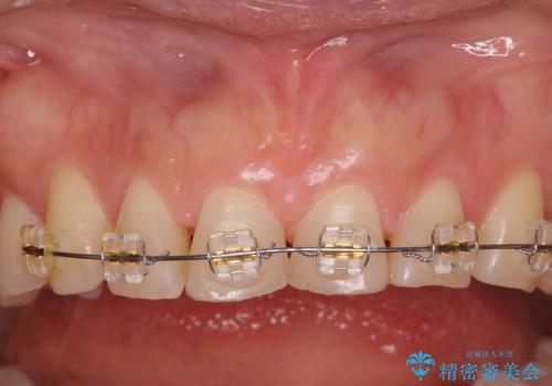 50代女性　部分矯正で　前歯の見た目改善　気になるところだけの治療中