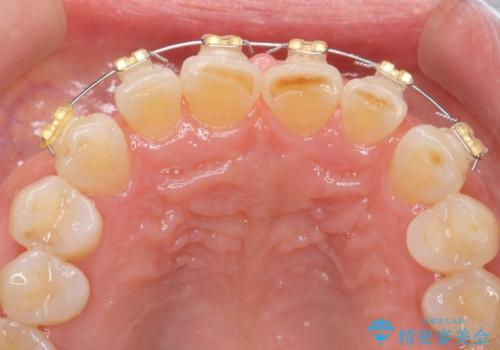 50代女性 部分矯正で 前歯の見た目改善 気になるところだけの治療中