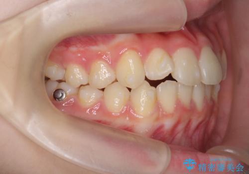 [ 前歯のねじれ改善 ]   中学生に行う早期マウスピース矯正治療の治療中