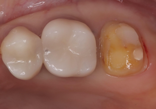 二次う蝕が心配の治療中