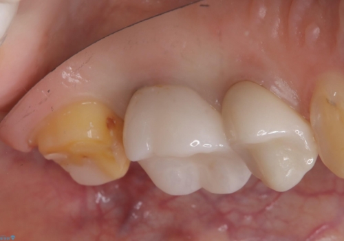 二次う蝕が心配の治療中
