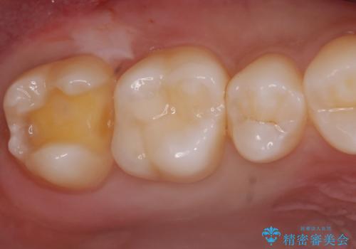 歯と歯の間の虫歯 e-maxインレーで修復の治療中