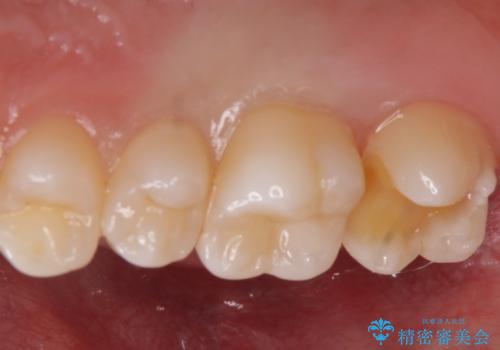 歯と歯の間の虫歯 e-maxインレーで修復の治療中