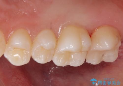 歯と歯の間の虫歯 e-maxインレーで修復の治療後