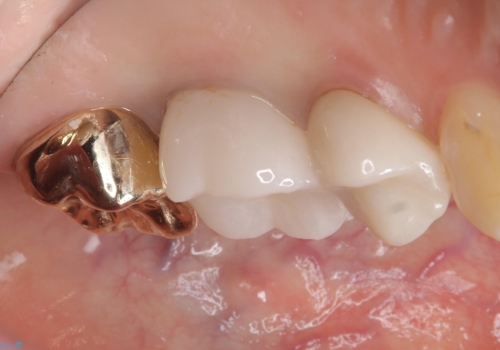 二次う蝕が心配の治療後