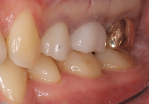 二次う蝕が心配の治療後