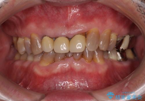 変色した前歯をきれいにしたい　部分矯正を併用した前歯の審美歯科治療の症例 治療前