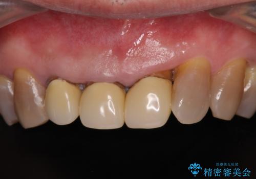 変色した前歯をきれいにしたい 部分矯正を併用した前歯の審美歯科治療の治療前