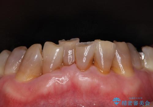 変色した前歯をきれいにしたい 部分矯正を併用した前歯の審美歯科治療の治療前