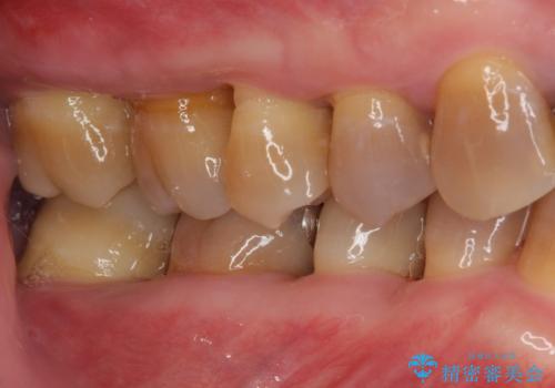 変色した前歯をきれいにしたい 部分矯正を併用した前歯の審美歯科治療の治療前