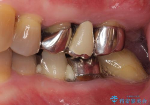 変色した前歯をきれいにしたい　部分矯正を併用した前歯の審美歯科治療の治療前