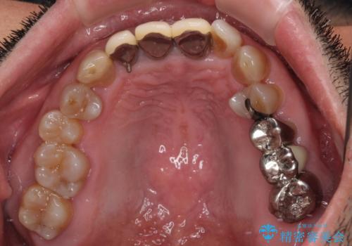 変色した前歯をきれいにしたい 部分矯正を併用した前歯の審美歯科治療の治療前