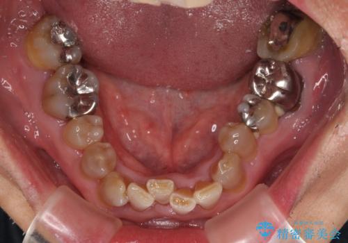 変色した前歯をきれいにしたい 部分矯正を併用した前歯の審美歯科治療の治療前