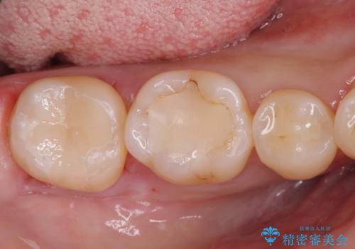 古い樹脂の劣化 セラミックインレー治療の症例 治療後