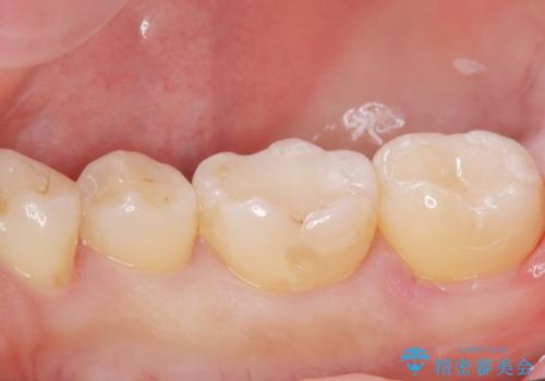 古い樹脂の劣化 セラミックインレー治療の治療後