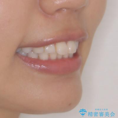 尖った前歯を引っ込めたい 目立たないワイヤー装置での抜歯矯正の治療前(顔貌)