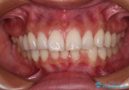 尖った前歯を引っ込めたい　目立たないワイヤー装置での抜歯矯正の症例 治療前