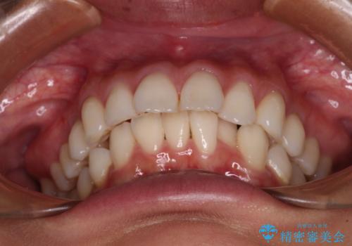 尖った前歯を引っ込めたい 目立たないワイヤー装置での抜歯矯正の治療前