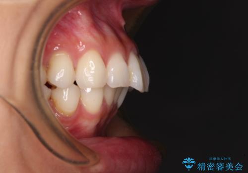 尖った前歯を引っ込めたい　目立たないワイヤー装置での抜歯矯正の治療前