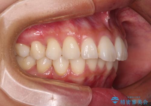 尖った前歯を引っ込めたい　目立たないワイヤー装置での抜歯矯正の治療前
