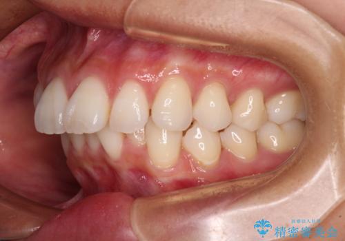 尖った前歯を引っ込めたい 目立たないワイヤー装置での抜歯矯正の治療前