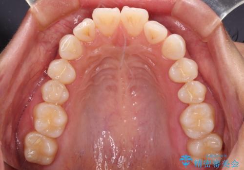 尖った前歯を引っ込めたい 目立たないワイヤー装置での抜歯矯正の治療前