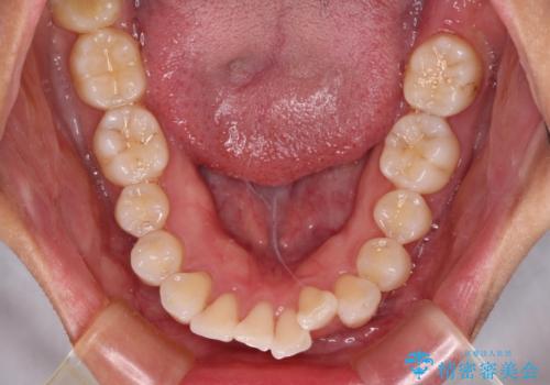 尖った前歯を引っ込めたい 目立たないワイヤー装置での抜歯矯正の治療前