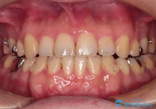 【モニター】舌のトレーニングを行いながら後戻りの再矯正の治療中