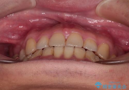 【モニター】舌のトレーニングを行いながら後戻りの再矯正の治療中