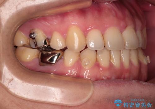 【モニター】舌のトレーニングを行いながら後戻りの再矯正の治療中