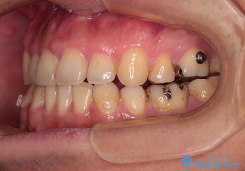 【モニター】舌のトレーニングを行いながら後戻りの再矯正の治療中