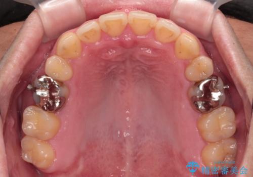 【モニター】舌のトレーニングを行いながら後戻りの再矯正の治療中